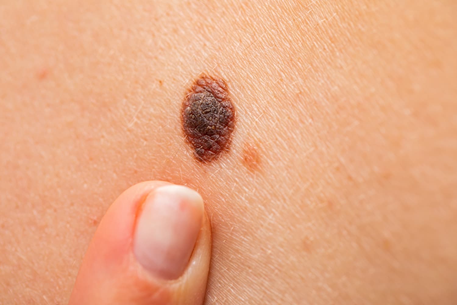 Raised dark brown melanocytic nevus on the skin, the kind a dermatologist assesses for benign features.