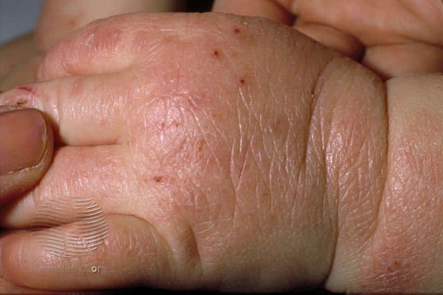 A child's hand with dry, rough and reddened skin showing signs of atopic dermatitis on the hand.