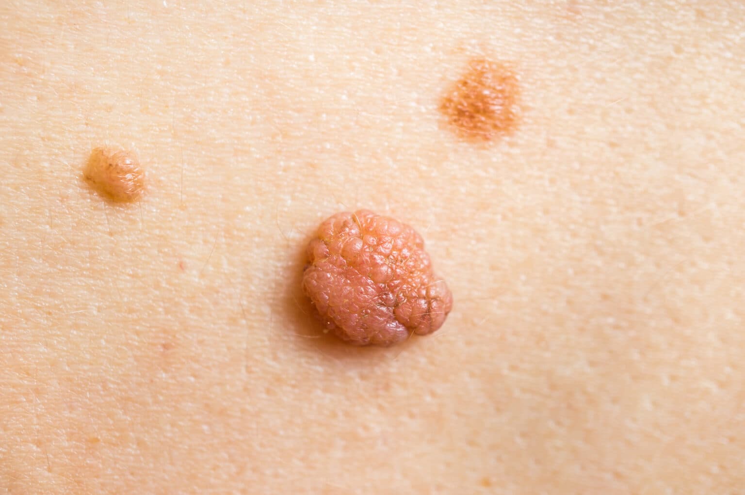 Raised papilloma and two pigmented moles on the skin, common skin growths assessed during a dermatology consultation.