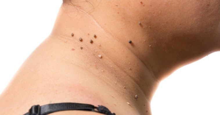Side of the neck showing several skin tags and pigmented moles along the skin.
