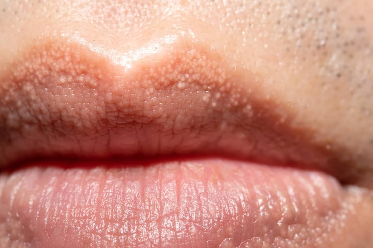 Small whitish-yellow papules along the lip border, characteristic of Fordyce spots.