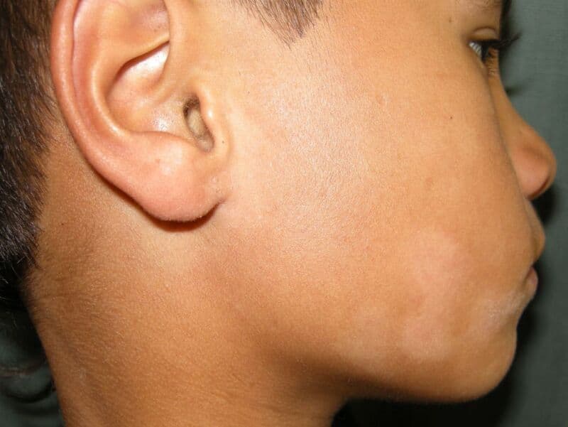 Pale hypopigmented patch on a child's cheek, characteristic of pityriasis alba.