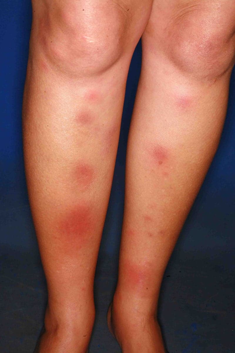 Painful red subcutaneous nodules on both shins, characteristic of erythema nodosum.
