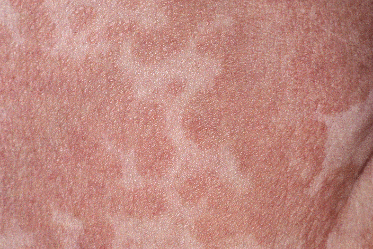 Lighter, irregularly shaped patches on the skin characteristic of tinea versicolor, a fungal infection.