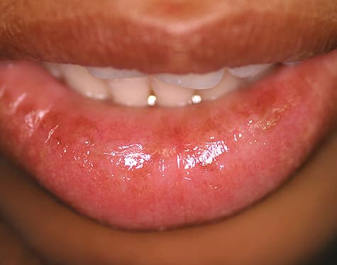 Swollen, reddened lower lip with signs of inflammation, consistent with glandular cheilitis.